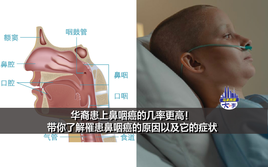 华裔患上鼻咽癌的几率更高！带你了解罹患鼻咽癌的原因以及它的症状